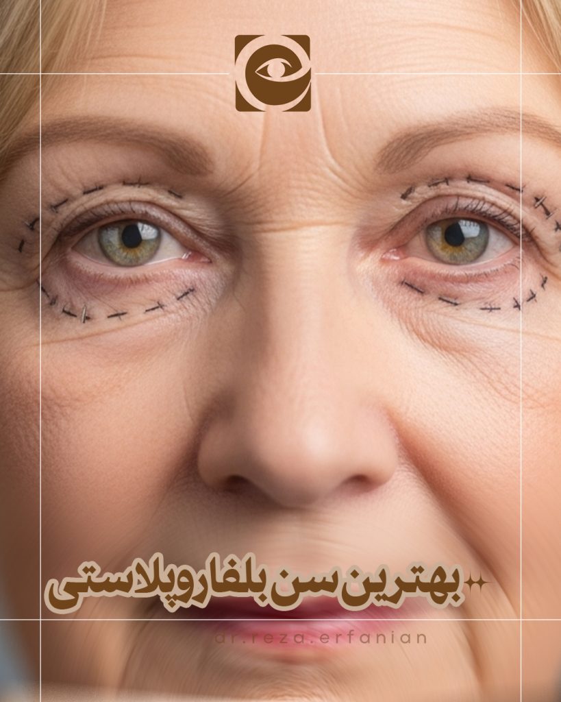 بهترین سن برای بلفاروپلاستی
