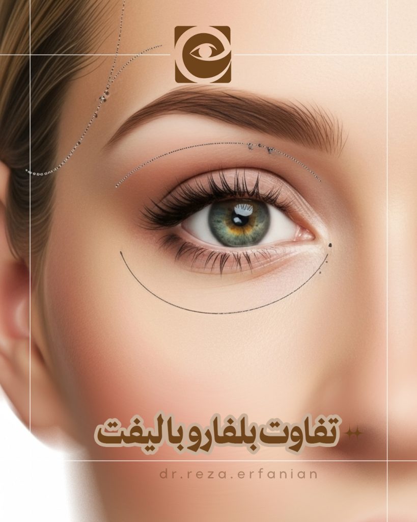تفاوت بلفاروپلاستی و لیفت شقیقه