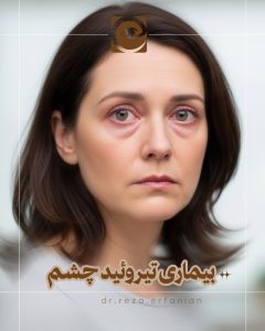 بیماری تیروئید چشم