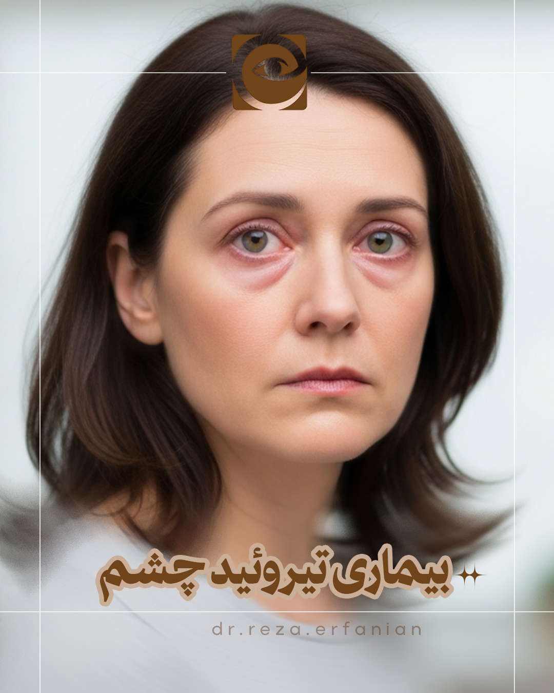 بیماری تیروئید چشم