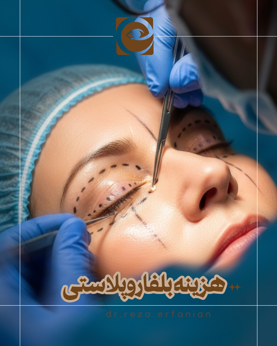 هزینه عمل بلفارو پلاستی