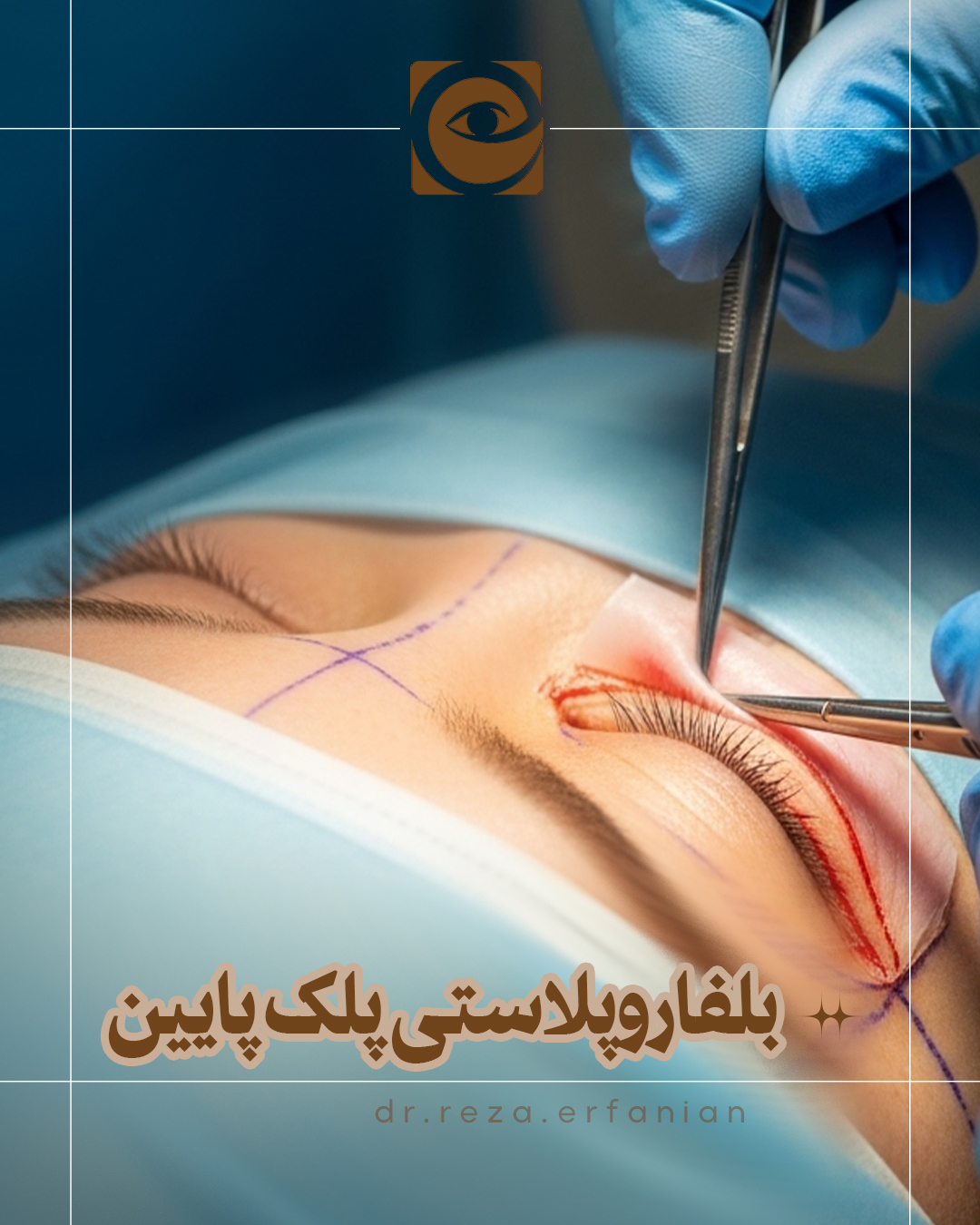 بلفاروپلاستی پلک پایین