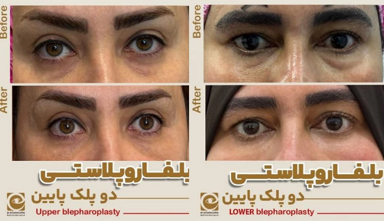 کاربردهای عمل بلفاروپلاستی کاربردهای عمل بلفاروپلاستی
