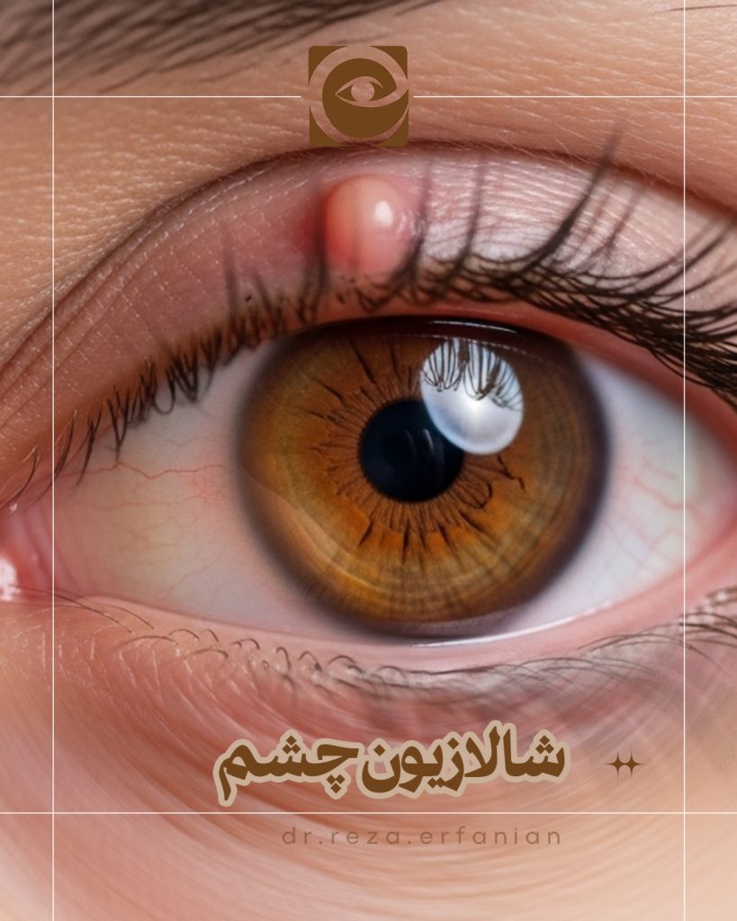 شالازیون چشم