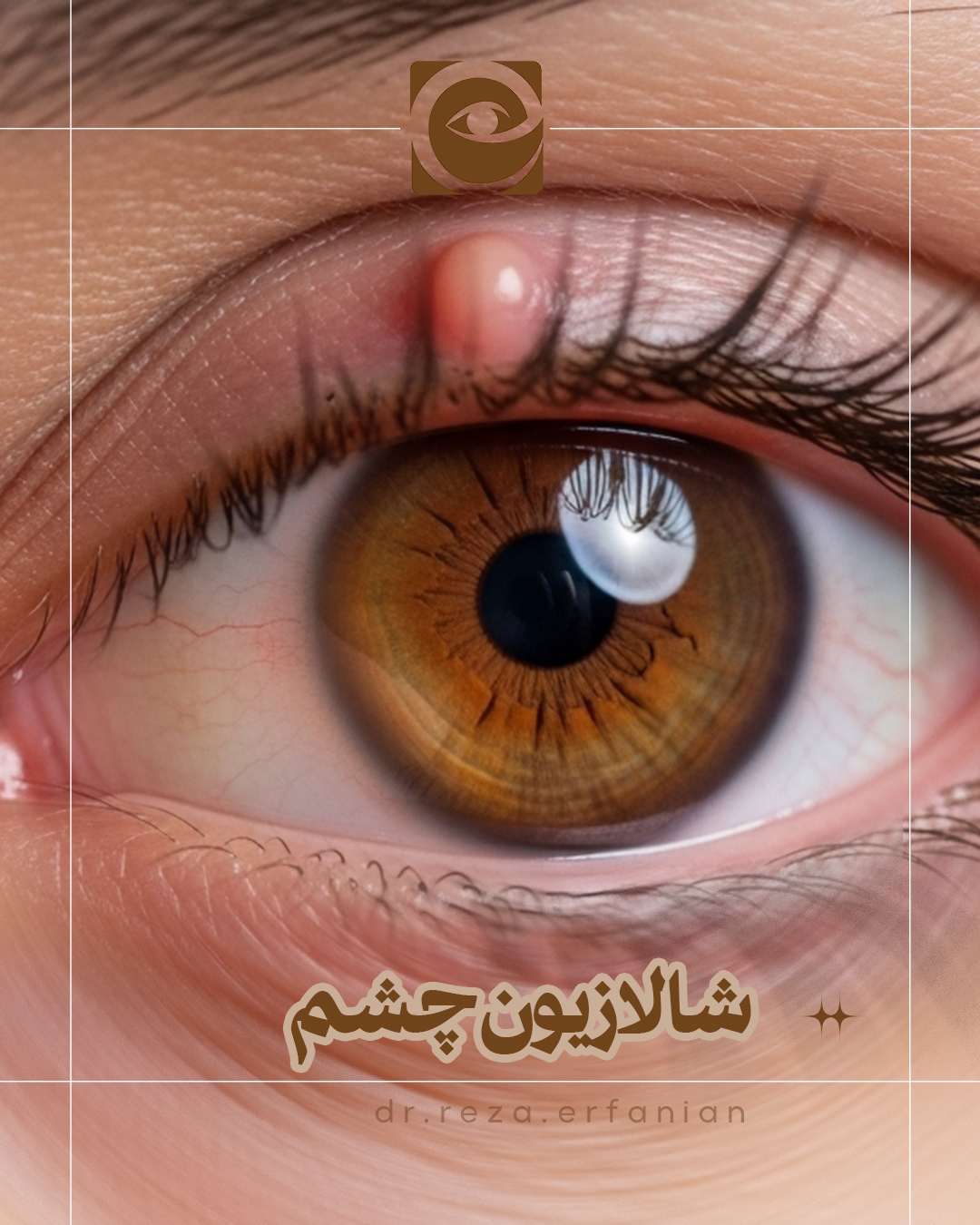 شالازیون چشم
