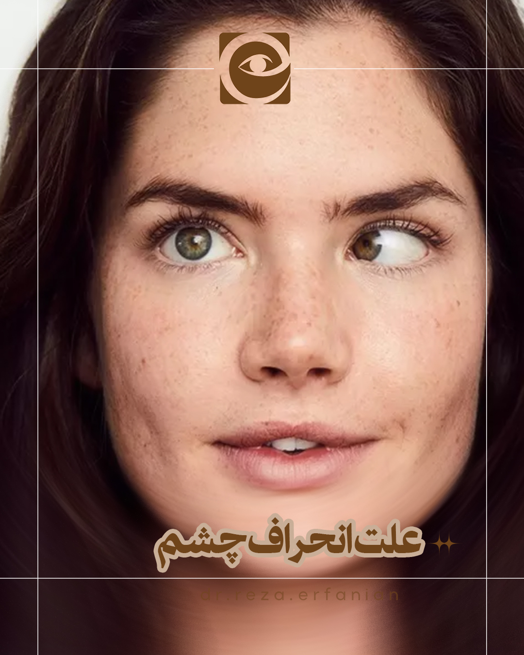درمان انحراف چشم