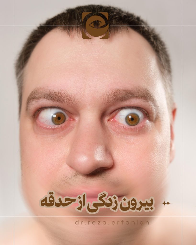 بیرون زدگی چشم از حدقه
