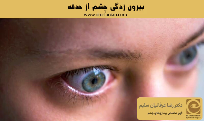 بیرون زدگی چشم از حدقه