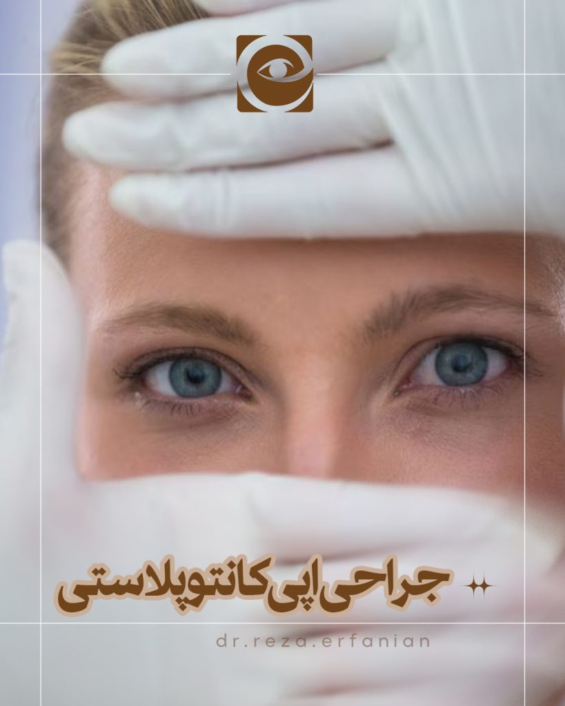 جراحی اپی کانتوپلاستی