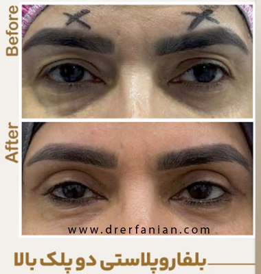 بلفاروپلاستی دو پلک بالا دکتر عرفانیان