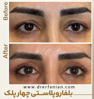 تصویر نمونه کار بلفاروپلاستی چهار پلک