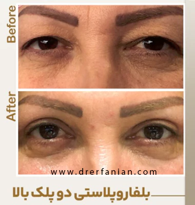 عکس جراحی پلک