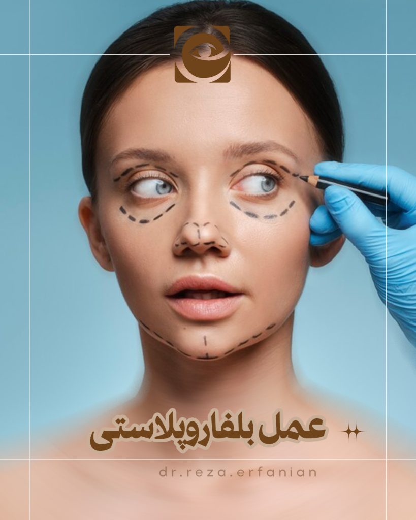عمل بلفاروپلاستی
