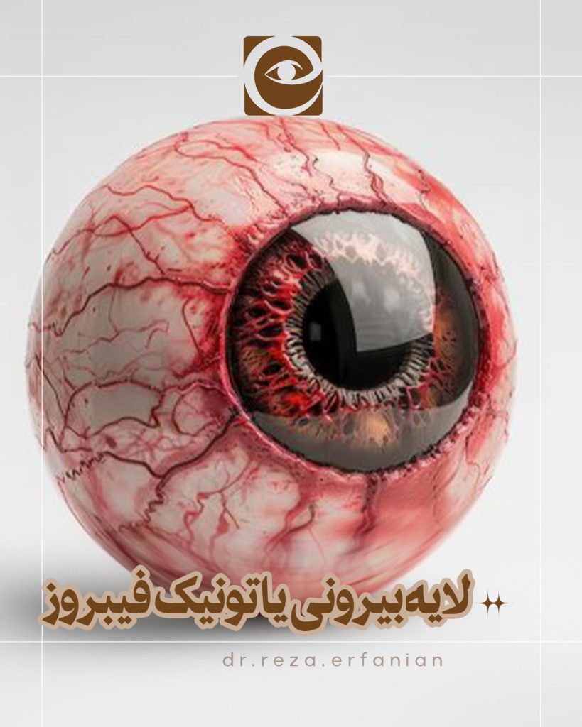 لایه بیرونی چشم یا تونیک فیبروز