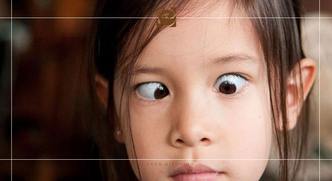 علائم و نشانههای هشداردهنده انحراف چشم