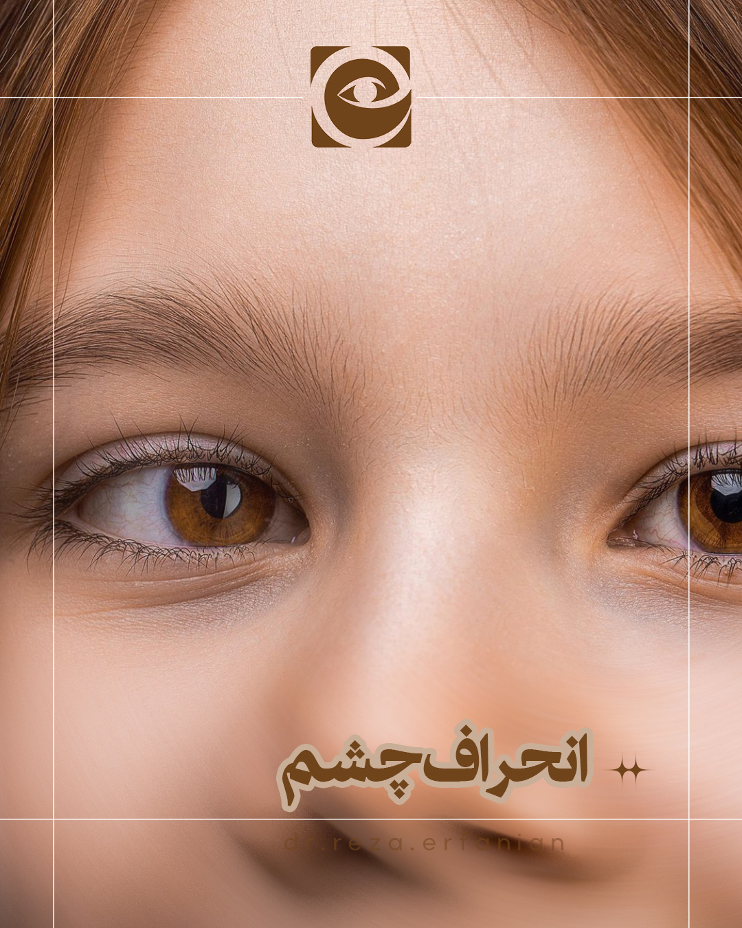 انحراف چشم (استرابیسم) چیست؟