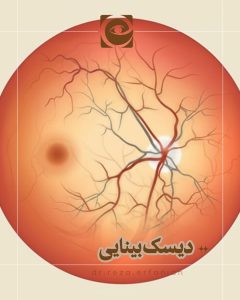 دیسک بینایی