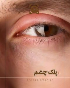 پلک چشم