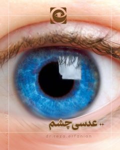 عدسی چشم